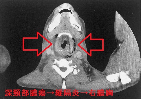深頸部膿瘍、縦隔炎、右膿胸 CT画像 深頸部膿瘍、縦隔炎、右膿胸 CT画像