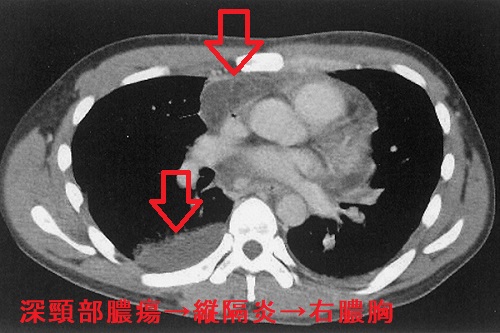 深頸部膿瘍、縦隔炎、右膿胸 CT画像 深頸部膿瘍、縦隔炎、右膿胸 CT画像