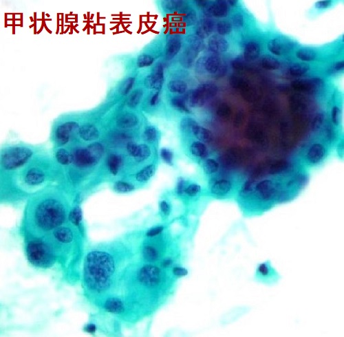 甲状腺粘表皮癌の穿刺細胞診 甲状腺粘表皮癌の穿刺細胞診