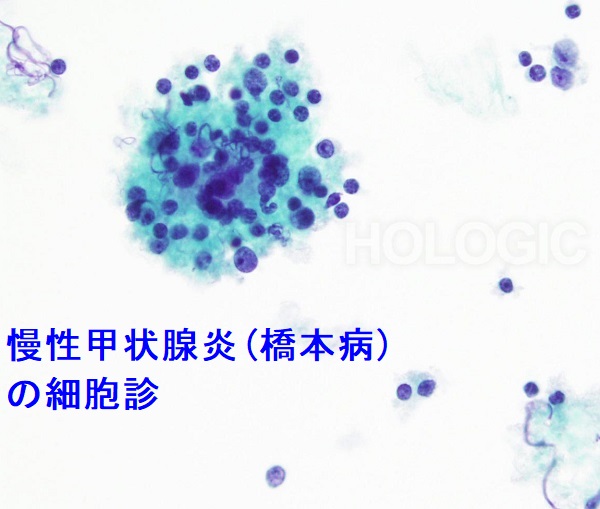 慢性甲状腺炎(橋本病)の穿刺細胞診所見 慢性甲状腺炎(橋本病)の穿刺細胞診所見