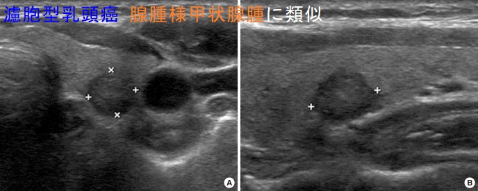 濾胞型乳頭癌 腺腫様甲状腺腫に類似 濾胞型乳頭癌 腺腫様甲状腺腫に類似