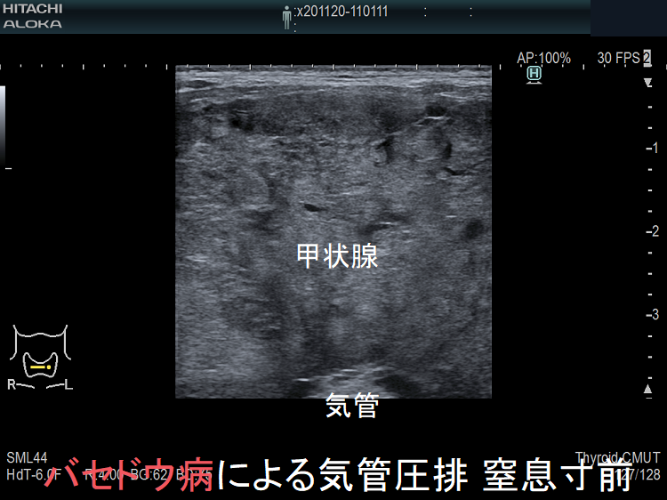 バセドウ病による気管圧排 窒息寸前 超音波(エコー)画像 バセドウ病による気管圧排 窒息寸前 超音波(エコー)画像