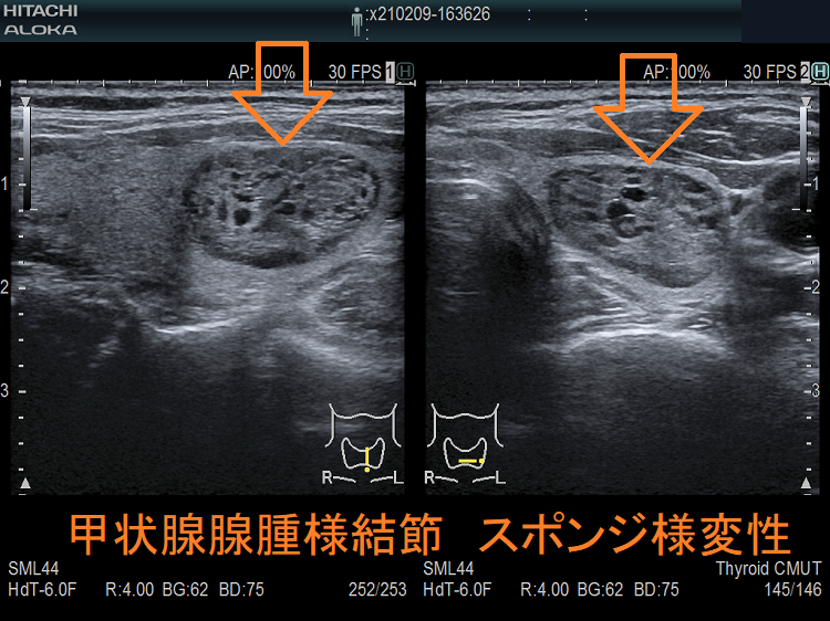 甲状腺腺腫様結節 スポンジ様変性 超音波(エコー)画像 甲状腺腺腫様結節 スポンジ様変性 超音波(エコー)画像