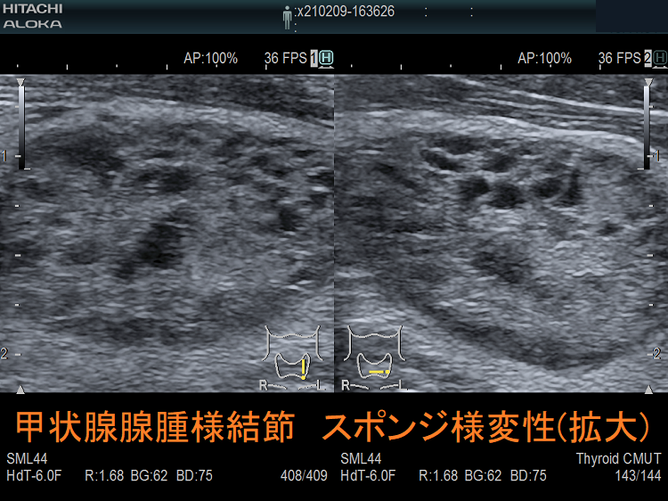 甲状腺腺腫様結節 スポンジ様変性 超音波(エコー)画像(拡大) 甲状腺腺腫様結節 スポンジ様変性 超音波(エコー)画像(拡大)