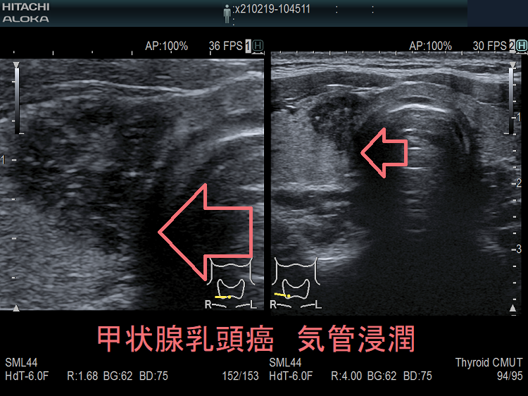 甲状腺乳頭癌 気管浸潤 超音波(エコー)画像 甲状腺乳頭癌 気管浸潤 超音波(エコー)画像