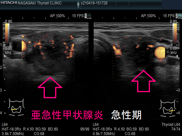 亜急性甲状腺炎の急性期 超音波(エコー)画像 ドプラーモード 亜急性甲状腺炎の急性期 超音波(エコー)画像 ドプラーモード