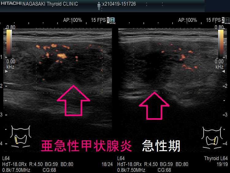 亜急性甲状腺炎の急性期 超音波(エコー)画像 ドプラーモード 亜急性甲状腺炎の急性期 超音波(エコー)画像 ドプラーモード