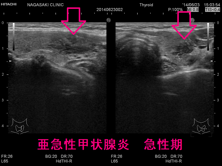 亜急性甲状腺炎 急性期 超音波(エコー)画像3 亜急性甲状腺炎 急性期 超音波(エコー)画像3