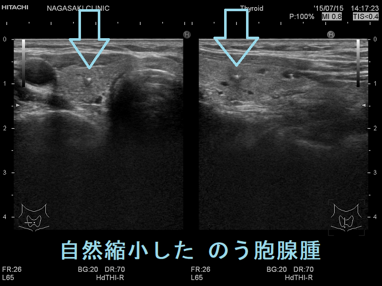自然縮小した のう胞腺腫 自然縮小した のう胞腺腫