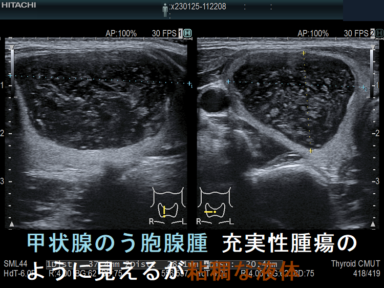 甲状腺のう胞腺腫 充実性腫瘍のように見えるが粘稠な液体 甲状腺のう胞腺腫 充実性腫瘍のように見えるが粘稠な液体