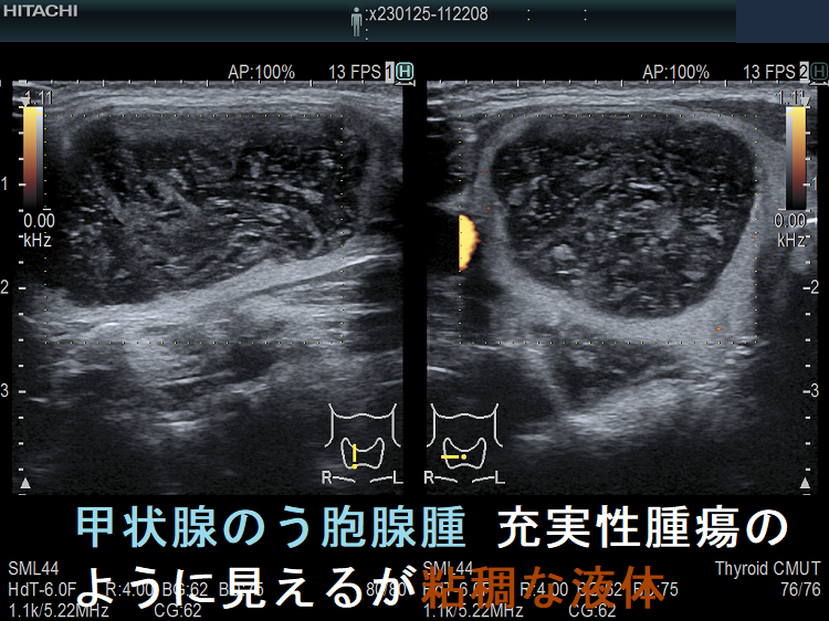 甲状腺のう胞腺腫 充実性腫瘍のように見えるが粘稠な液体 ドプラーモード 甲状腺のう胞腺腫 充実性腫瘍のように見えるが粘稠な液体 ドプラーモード