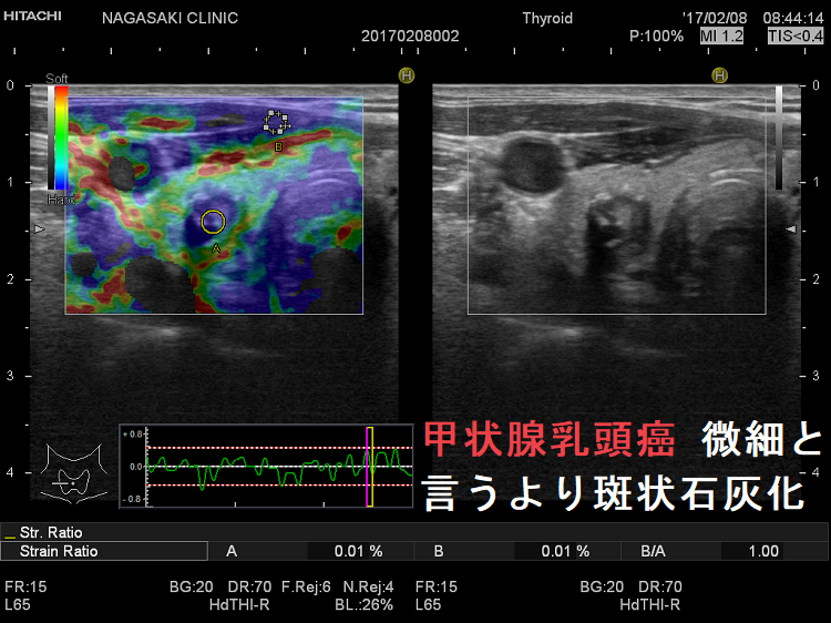 甲状腺乳頭癌 微細と言うより斑状石灰化 甲状腺乳頭癌 微細と言うより斑状石灰化