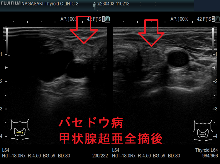 バセドウ病超亜全摘術(準全摘術)後 超音波(エコー)画像 バセドウ病超亜全摘術(準全摘術)後 超音波(エコー)画像