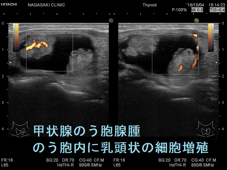 甲状腺のう胞腺腫 のう胞内に乳頭状の細胞増殖 ドプラーモード 甲状腺のう胞腺腫 のう胞内に乳頭状の細胞増殖 ドプラーモード