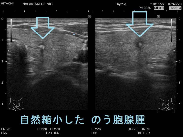自然縮小した のう胞腺腫 超音波(エコー)画像 自然縮小した のう胞腺腫 超音波(エコー)画像