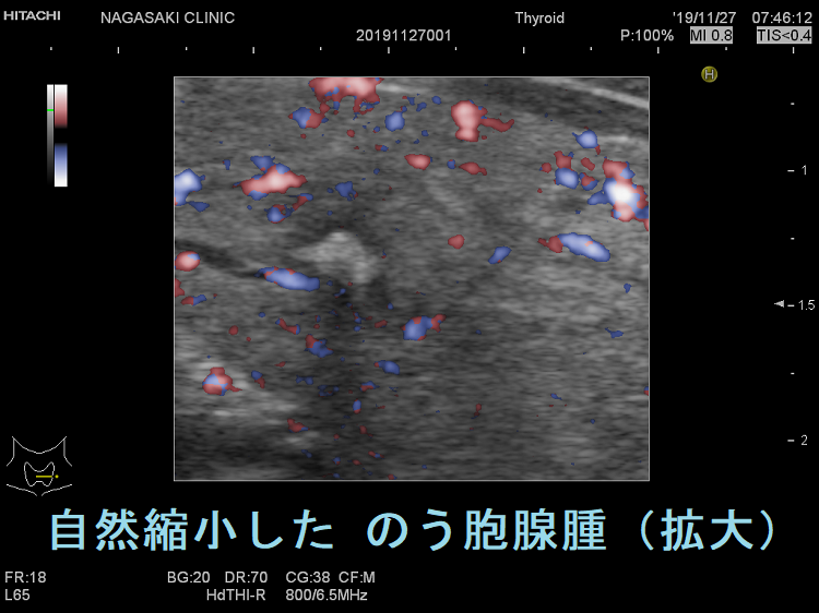 自然縮小した のう胞腺腫 超音波(エコー)画像(拡大) 自然縮小した のう胞腺腫 超音波(エコー)画像(拡大)