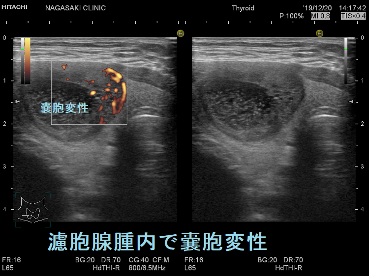 濾胞腺腫内で嚢胞変性 濾胞腺腫内で嚢胞変性
