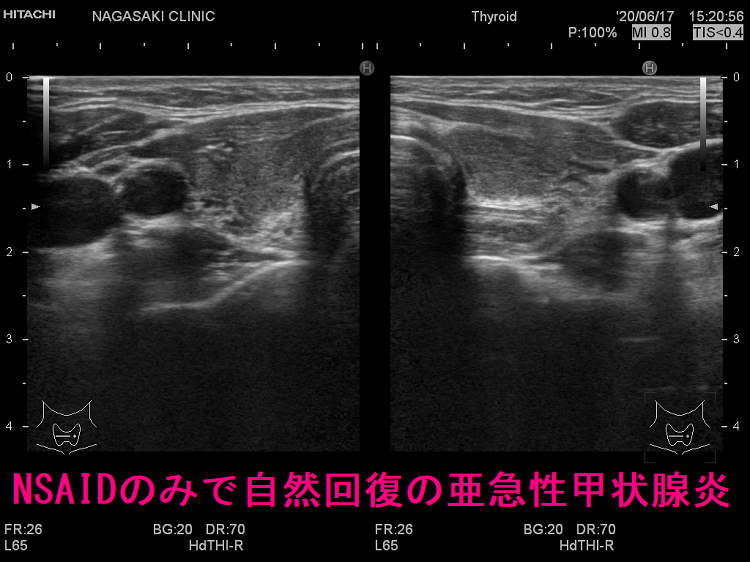NSAIDのみで自然回復の亜急性甲状腺炎(水平断) NSAIDのみで自然回復の亜急性甲状腺炎(水平断)