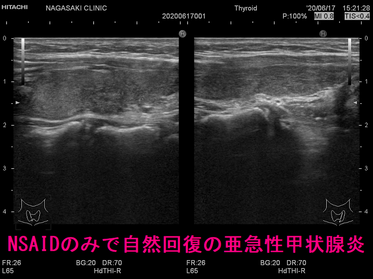 NSAIDのみで自然回復の亜急性甲状腺炎(垂直断) NSAIDのみで自然回復の亜急性甲状腺炎(垂直断)