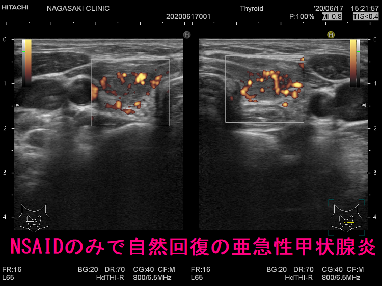 NSAIDのみで自然回復の亜急性甲状腺炎 ドプラーモード NSAIDのみで自然回復の亜急性甲状腺炎 ドプラーモード