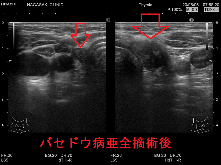 バセドウ病亜全摘術後 超音波(エコー)画像 (水平断) バセドウ病亜全摘術後 超音波(エコー)画像 (水平断)
