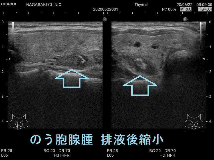 のう胞腺腫 排液後縮小 超音波(エコー)画像 のう胞腺腫 排液後縮小 超音波(エコー)画像