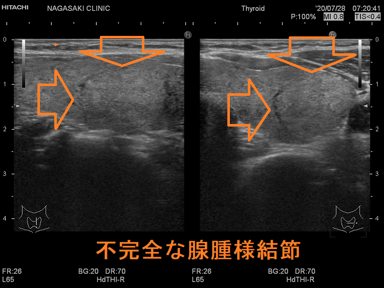 不完全な腺腫様結節 超音波(エコー)画像 不完全な腺腫様結節 超音波(エコー)画像