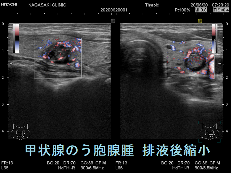 甲状腺のう胞腺腫 排液後縮小 超音波(エコー)画像 ドプラーモード 甲状腺のう胞腺腫 排液後縮小 超音波(エコー)画像 ドプラーモード