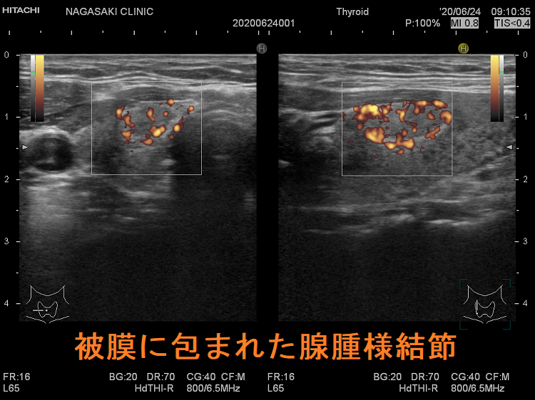 被膜に包まれた腺腫様結節 超音波(エコー)画像 ドプラーモード 被膜に包まれた腺腫様結節 超音波(エコー)画像 ドプラーモード