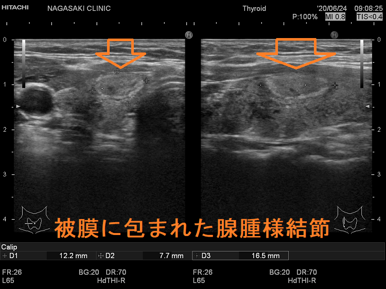 被膜に包まれた腺腫様結節 超音波(エコー)画像 被膜に包まれた腺腫様結節 超音波(エコー)画像