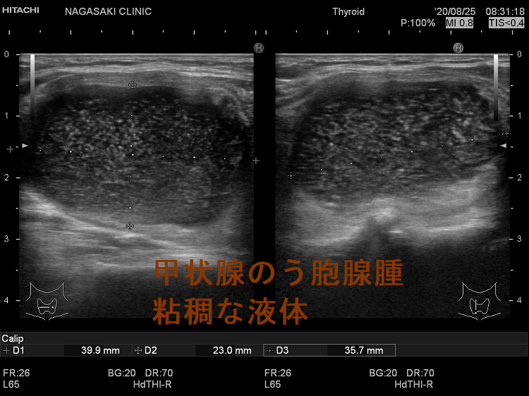 甲状腺のう胞腺腫 粘稠な液体 甲状腺のう胞腺腫 粘稠な液体