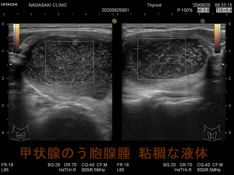 甲状腺のう胞腺腫 粘稠な液体 ドプラー 甲状腺のう胞腺腫 粘稠な液体 ドプラーモード
