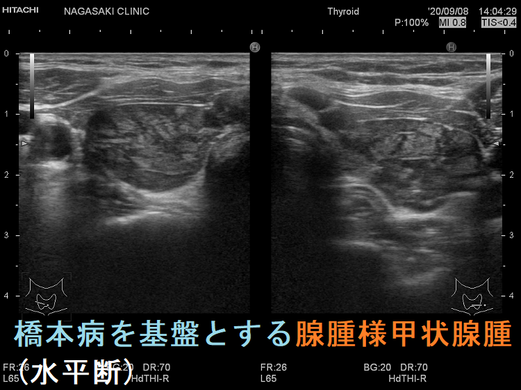 橋本病を基盤とする腺腫様甲状腺腫(水平断) 橋本病を基盤とする腺腫様甲状腺腫(水平断)