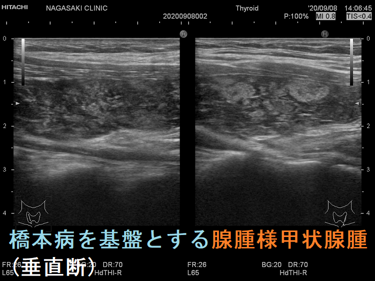 橋本病を基盤とする腺腫様甲状腺腫(垂直断) 橋本病を基盤とする腺腫様甲状腺腫(垂直断)