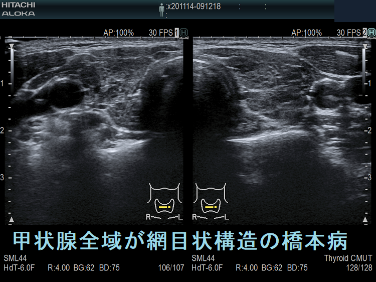 甲状腺全域が網目状構造の橋本病(水平断) 甲状腺全域が網目状構造の橋本病(水平断)
