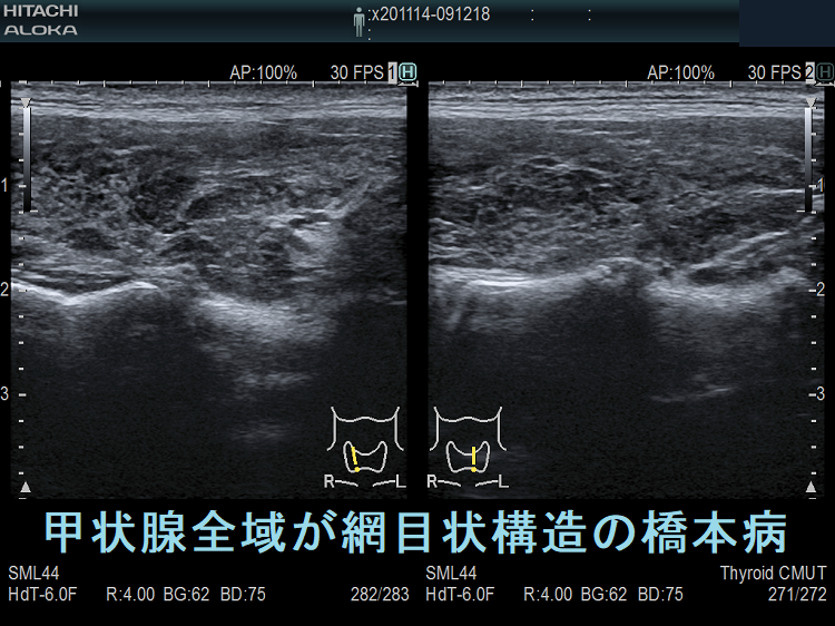甲状腺全域が網目状構造の橋本病(垂直断) 甲状腺全域が網目状構造の橋本病(垂直断)