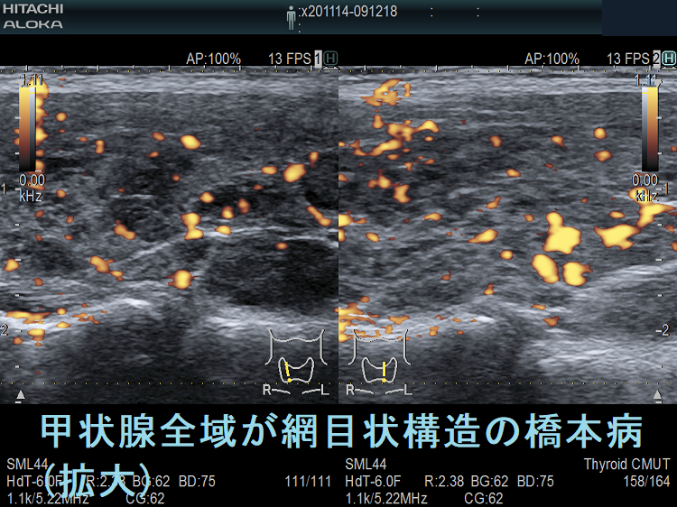 甲状腺全域が網目状構造の橋本病(拡大) 甲状腺全域が網目状構造の橋本病(拡大)