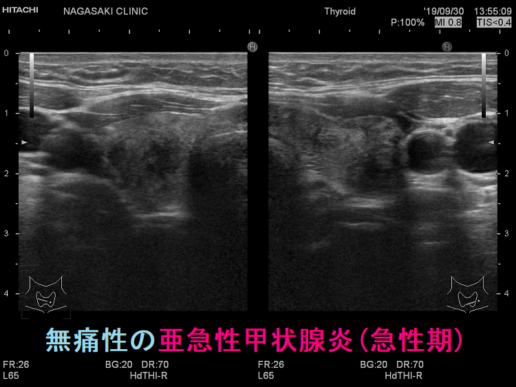 無痛性の亜急性甲状腺炎(急性期) 無痛性の亜急性甲状腺炎(急性期)