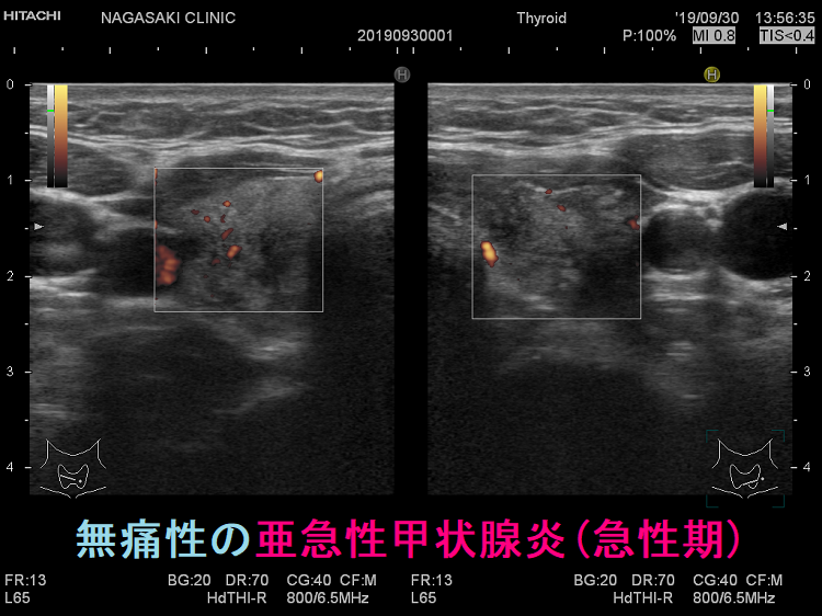 無痛性の亜急性甲状腺炎(急性期) ドプラーモード 無痛性の亜急性甲状腺炎(急性期) ドプラーモード