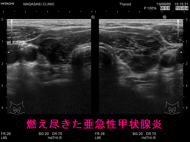 燃え尽きた亜急性甲状腺炎 超音波(エコー)画像 燃え尽きた亜急性甲状腺炎 超音波(エコー)画像