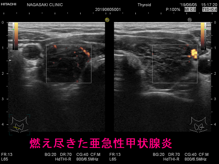 燃え尽きた亜急性甲状腺炎 超音波(エコー)画像 ドプラーモード 燃え尽きた亜急性甲状腺炎 超音波(エコー)画像 ドプラーモード