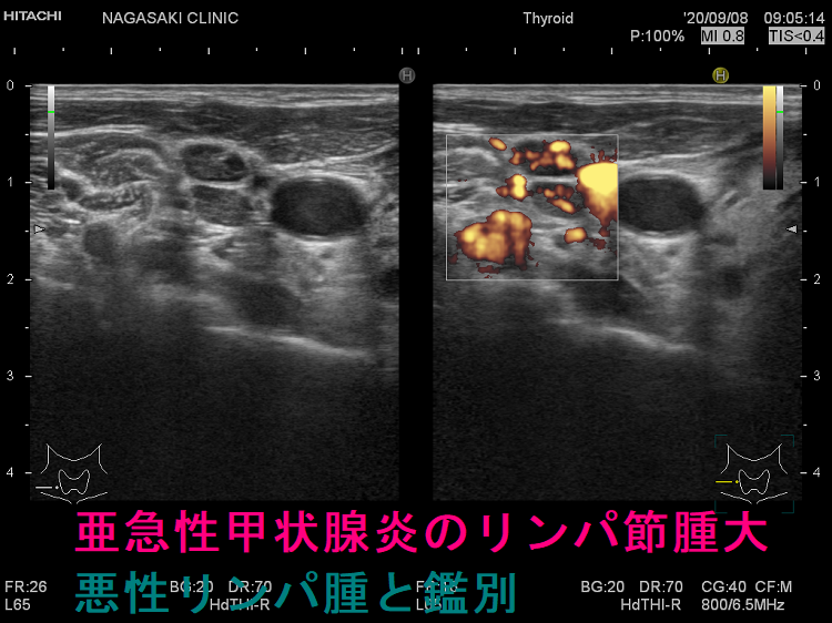亜急性甲状腺炎のリンパ節腫大 悪性リンパ腫と鑑別 亜急性甲状腺炎のリンパ節腫大 悪性リンパ腫と鑑別