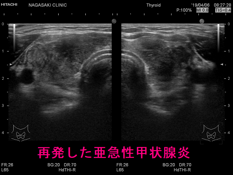 再発した亜急性甲状腺炎 超音波(エコー)画像 再発した亜急性甲状腺炎 超音波(エコー)画像