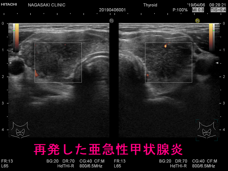 亜急性甲状腺炎再発 超音波(エコー)画像 ドプラーモード 亜急性甲状腺炎再発 超音波(エコー)画像 ドプラーモード