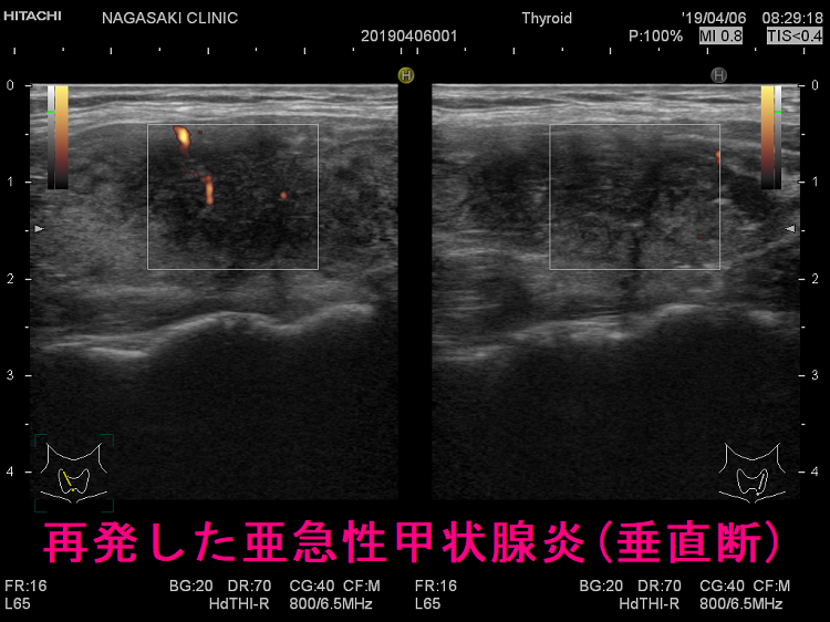再発した亜急性甲状腺炎 超音波(エコー)画像 (垂直断) 再発した亜急性甲状腺炎 超音波(エコー)画像 (垂直断)