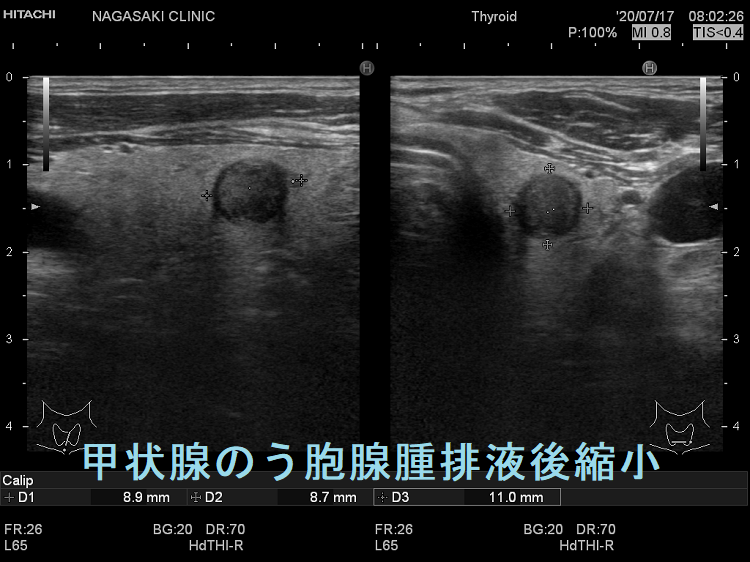 甲状腺のう胞腺腫排液後縮小 甲状腺のう胞腺腫排液後縮小