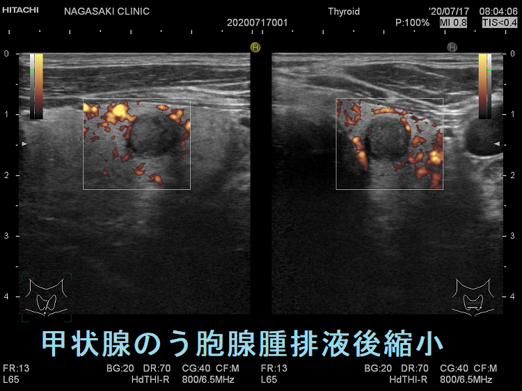 甲状腺のう胞腺腫排液後縮小 ドプラーモード 甲状腺のう胞腺腫排液後縮小 ドプラーモード