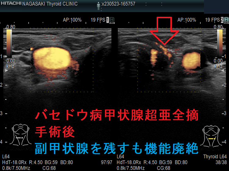 バセドウ病甲状腺超亜全摘手術後 副甲状腺を残すも機能廃絶 ドプラーモード バセドウ病甲状腺超亜全摘手術後 副甲状腺を残すも機能廃絶 ドプラーモード