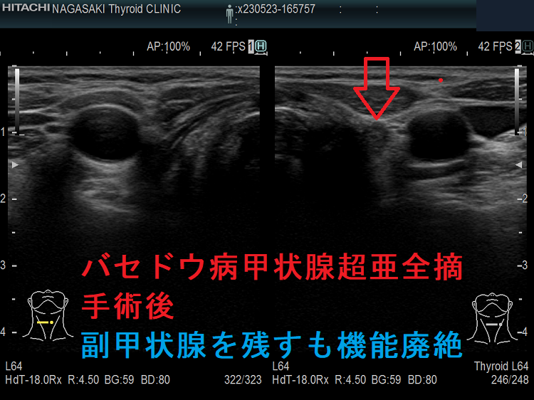 バセドウ病甲状腺超亜全摘手術後 副甲状腺を残すも機能廃絶 バセドウ病甲状腺超亜全摘手術後 副甲状腺を残すも機能廃絶