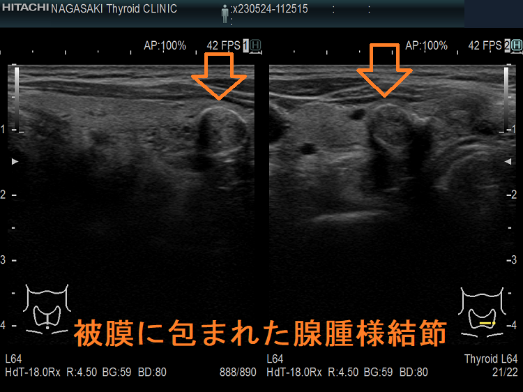 例外的に被膜に包まれた腺腫様結節 超音波(エコー)画像 例外的に被膜に包まれた腺腫様結節 超音波(エコー)画像
